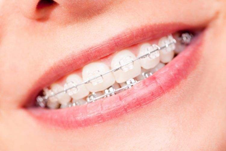 orthodontic treatment