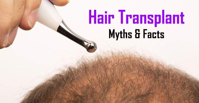Myths about Hair Transplantation