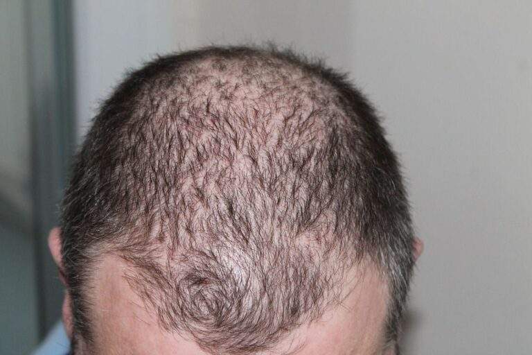 What are Early Signs of Balding and How to Stop Them