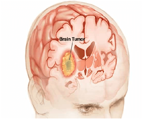 Brain Tumour What is it and how can it Affect you