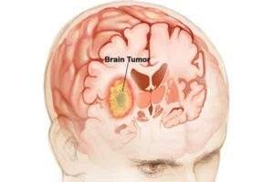 brain-tumor