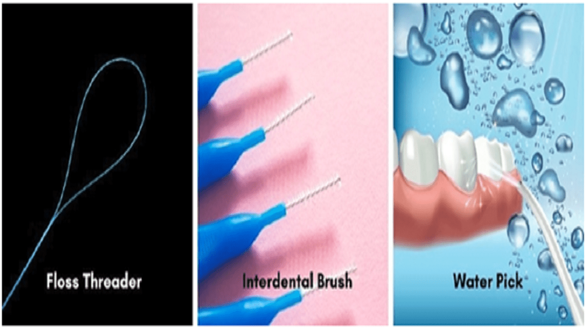 how to care dental bridge