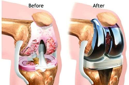 Everything You Need To Know About Knee Replacement