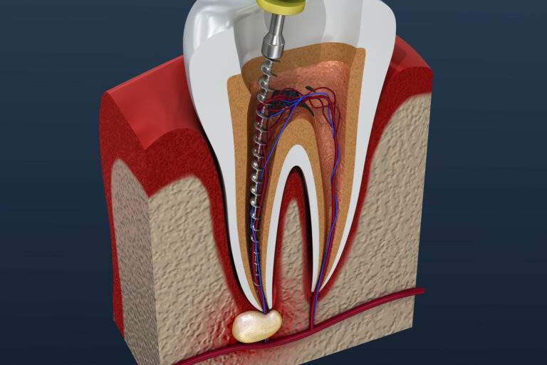 The Benefits of a Root Canal?