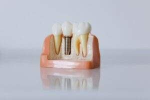 Tooth Replacement